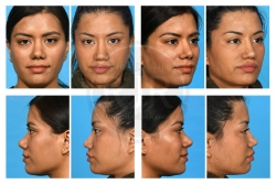 Tertiary Rhinoplasty with Alar Base Reduction an MTF rib graft for Nasal Collapse Correction Tertiary Rhinoplasty with Alar Base Reduction an MTF rib graft for Nasal Collapse Correction