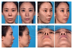 Revision Rhinoplasty After Six Prior Nasal Surgeries