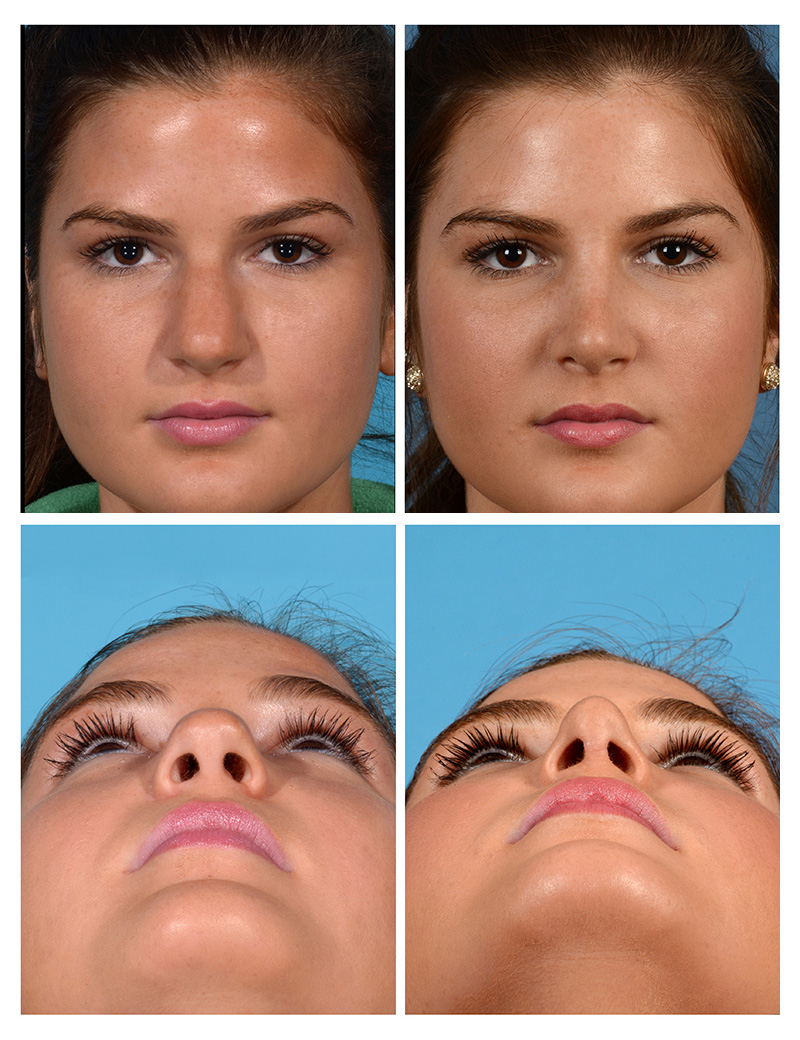 Rhinoplasty Before And After Women
