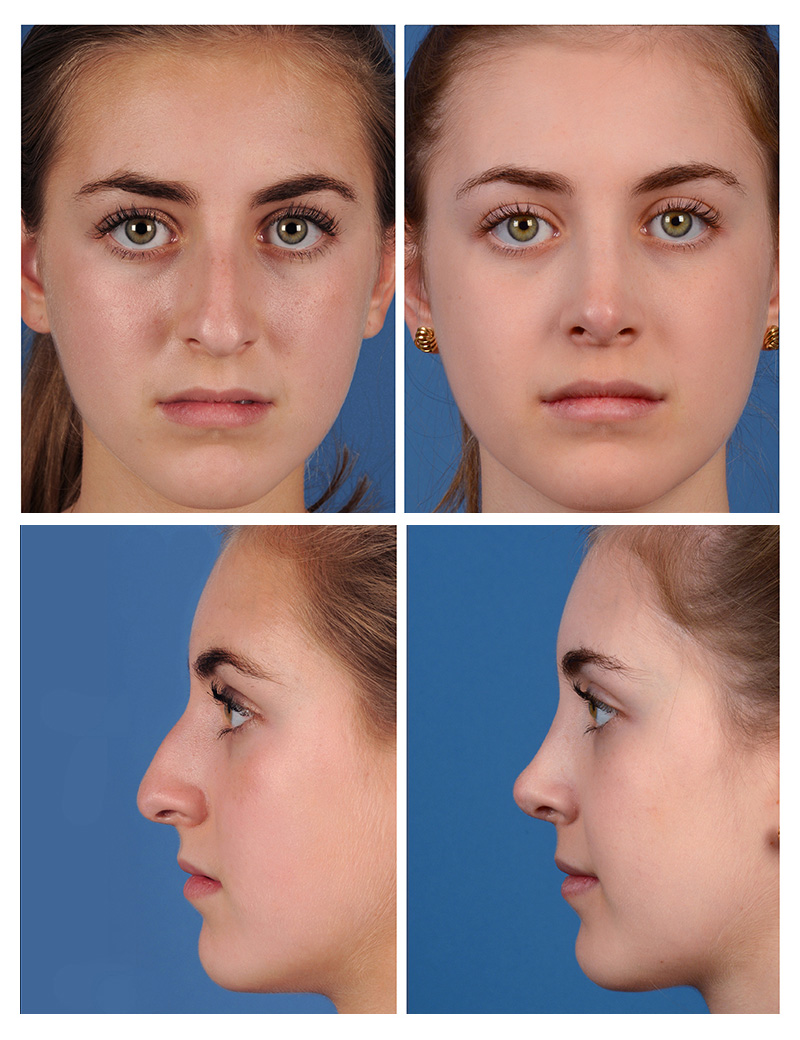 nose job for wide nose before and after