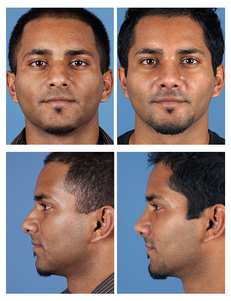 What is Upturned Nose Rhinoplasy?