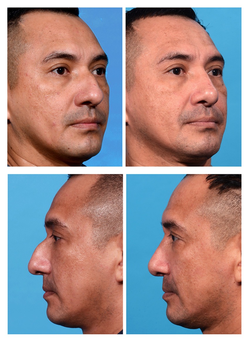 Nose Job Before And After Men