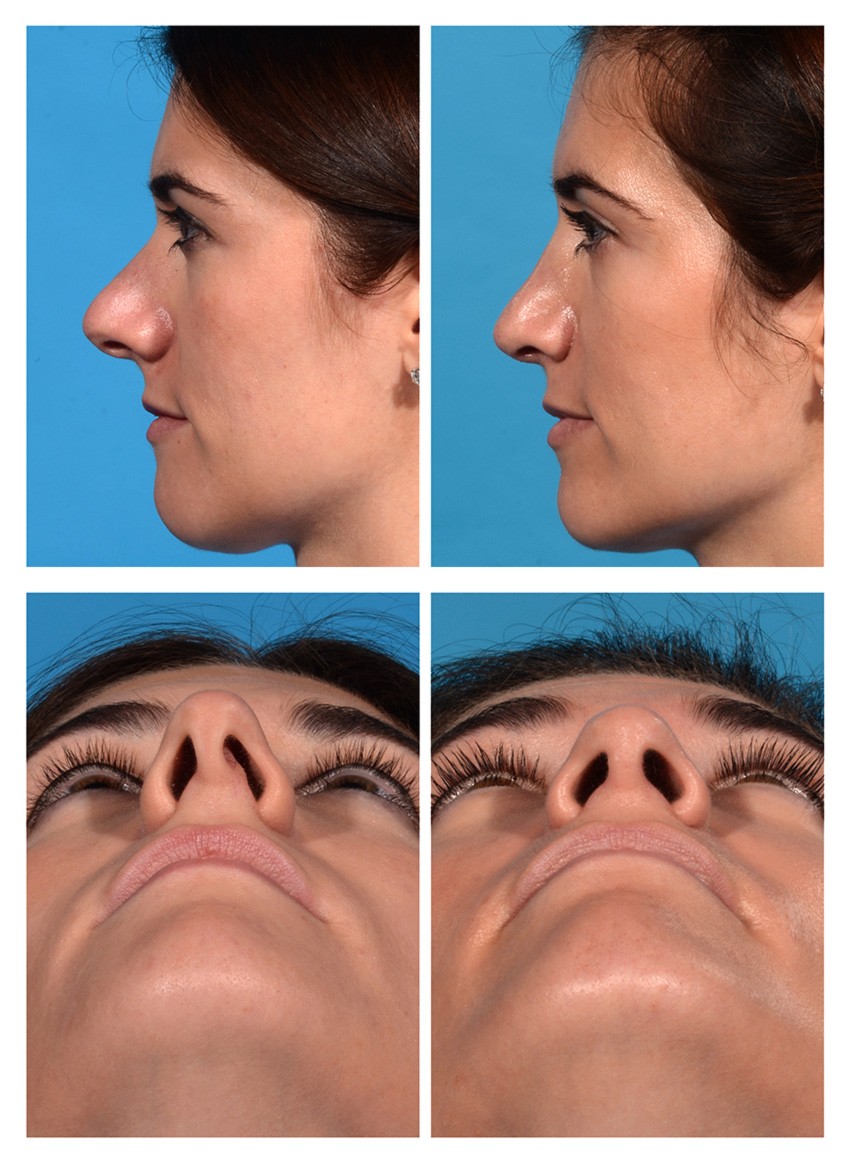 Rhinoplasty with Dorsal Hump Before and After Photos