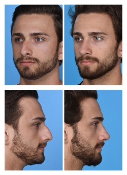 Male Rhinoplasty: Deviated Nose, Dorsal Hump, Bulbous Tip