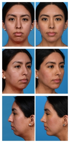 Rhinoplasty, Fat Removal, Chin Augmentation, Liposuction of the Neck