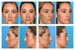 Rhinoplasty with Alar Base Resection