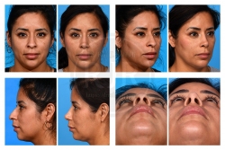 Rhinoplasty with Chin Augmentation, Dorsal Humb, Drooping Tip