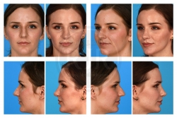 Rhinoplasty with Septal Reconstruction