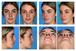 Rhinoplasty, Dorsum, Tip, Breathing