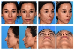 Rhinoplasty with Alar Base Resection