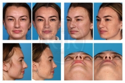 Rhinoplasty, Deviated Septum, Dorsal Hump