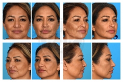 Rhinoplasty with Alar Base Resection, U/L Blepharoplasty, Facial Fat Augmentation