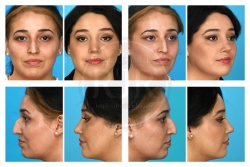 Rhinoplasty with Septal Reconstruction