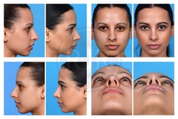 Preservation Rhinoplasty