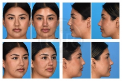 Rhinoplasty, Septal Reconstruction/Alar Base Resection, Buccal Fat Removal