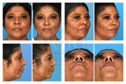 Open Rhinoplasty with Alar Base Reduction for Dorsal Hump and Nasal Shortening Open Rhinoplasty with Alar Base Reduction for Dorsal Hump and Nasal Shortening