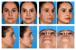Open Rhinoplasty and Chin Augmentation for Nasal Deviation and Microgenia Open Rhinoplasty and Chin Augmentation for Nasal Deviation and Microgenia