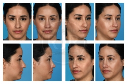 Open Rhinoplasty for Long Deviated Nose with Dorsal Hump