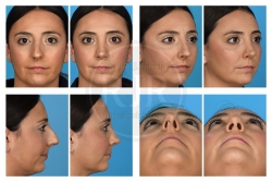 Open Rhinoplasty for Long Deviated Nose with Dorsal Hump