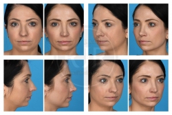 Open Rhinoplasty with Alar Base Reduction and Septal Reconstruction