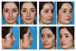 Precision Rhinoplasty with Nasal Bridge and Tip Refinement