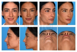 Rhinoplasty, Deviated Nose