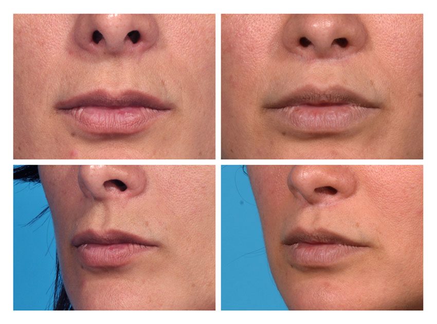 Lip Lift Patient 1