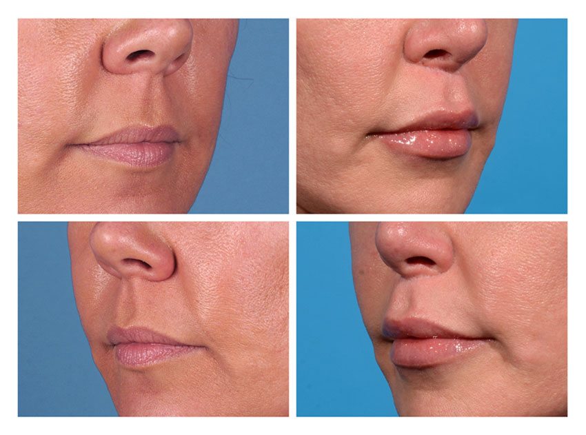 Lip Lift Patient 2