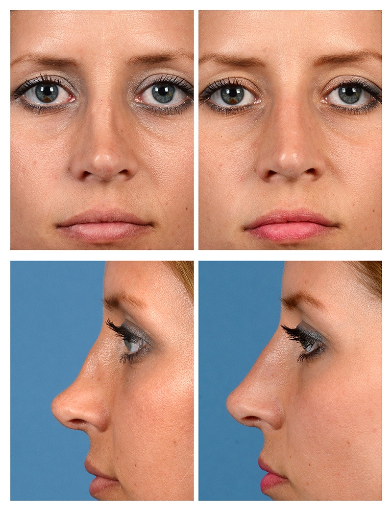 Nose Job Before And After Women Side View