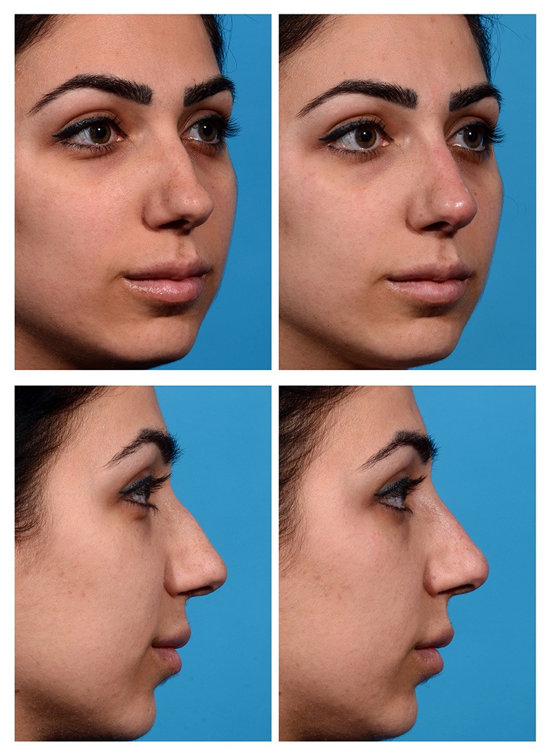 liquid rhinoplasty