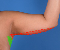 Arm Lift Surgery For Flabby Arms - Ganchi Plastic Surgery